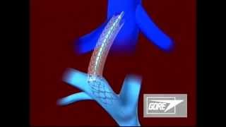 Endoprosthesis  Transjugular Intrahepatic Portosystemic Shunt TIPS [upl. by Enier]