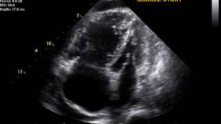 Pulmonary Hypertension echo [upl. by Wellesley]