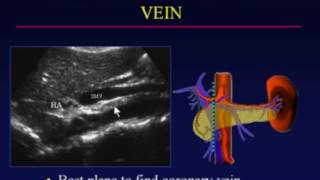 Ultrasound Evaluation of Portal Hypertension [upl. by Erdnoed]