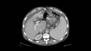 Transjugular Intrahepatic Portosystemic Shunt TIPS [upl. by Guimar]