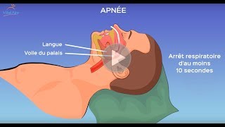 L’apnée du sommeil qu’estce que c’est [upl. by Llehcor]