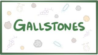 Gallstones cholelithiasis [upl. by Ynttirb]