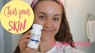 How To Get Rid of Acne  My Doxycycline Experience [upl. by Audley]