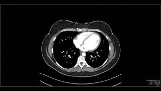 Abdominal Anatomy on Computed Tomography [upl. by Gmur616]