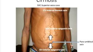 Interpreting abdominal wall veins [upl. by Ataliah]