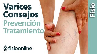 Mala circulación y varices  10 consejos para su prevención y tratamiento [upl. by Gnut535]